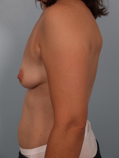 Breast Augmentation Before Photo | Phoenix and Scottsdale, AZ | Scottsdale Center for Plastic Surgery
