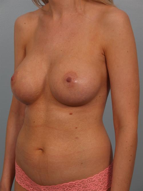 Breast Augmentation After Photo | Phoenix and Scottsdale, AZ | Scottsdale Center for Plastic Surgery
