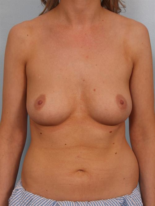 Breast Augmentation Before Photo | Phoenix and Scottsdale, AZ | Scottsdale Center for Plastic Surgery