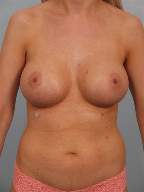 Breast Augmentation After Photo | Phoenix and Scottsdale, AZ | Scottsdale Center for Plastic Surgery