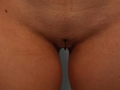 Labia Reduction Before Photo | Phoenix and Scottsdale, AZ | Scottsdale Center for Plastic Surgery