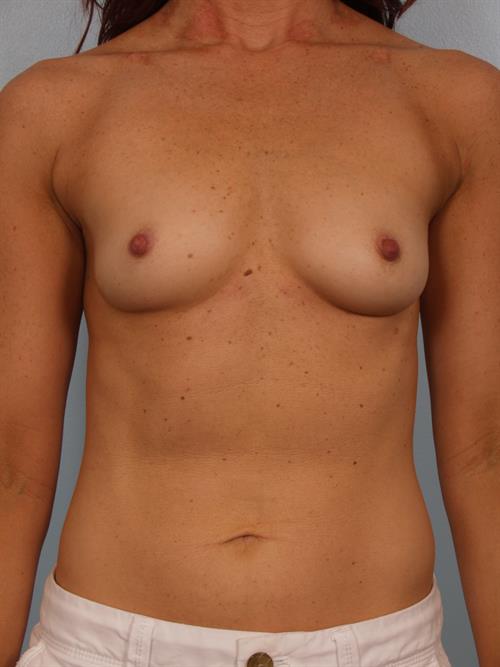 Breast Augmentation Before Photo | Phoenix and Scottsdale, AZ | Scottsdale Center for Plastic Surgery