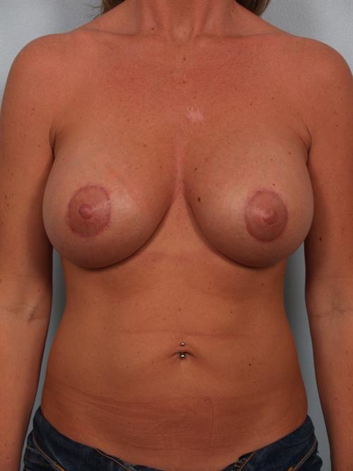 Breast Augmentation After Photo | Phoenix and Scottsdale, AZ | Scottsdale Center for Plastic Surgery