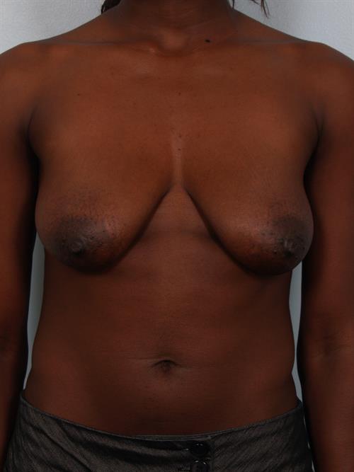 Breast Lift (Mastopexy) Before Photo | Phoenix and Scottsdale, AZ | Scottsdale Center for Plastic Surgery