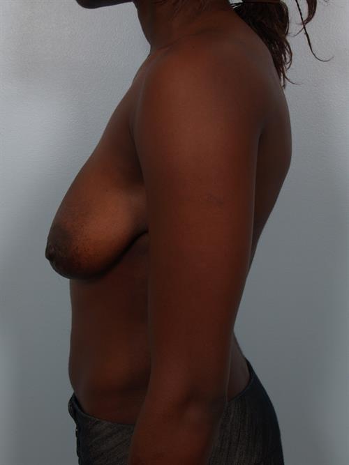 Breast Lift (Mastopexy) Before Photo | Phoenix and Scottsdale, AZ | Scottsdale Center for Plastic Surgery