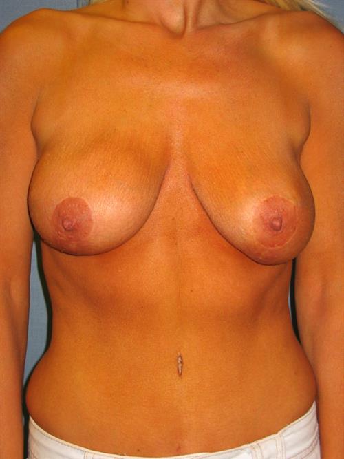 Revision Breast Surgery Before Photo | Phoenix and Scottsdale, AZ | Scottsdale Center for Plastic Surgery