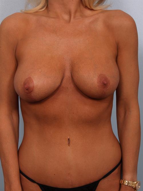 Revision Breast Surgery After Photo | Phoenix and Scottsdale, AZ | Scottsdale Center for Plastic Surgery