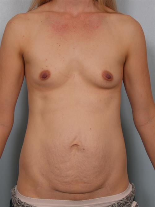 Breast Augmentation Before Photo | Phoenix and Scottsdale, AZ | Scottsdale Center for Plastic Surgery