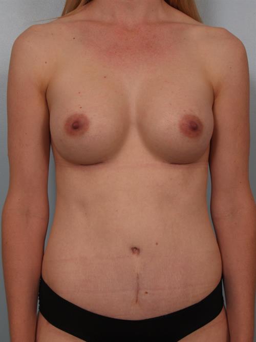Breast Augmentation After Photo | Phoenix and Scottsdale, AZ | Scottsdale Center for Plastic Surgery