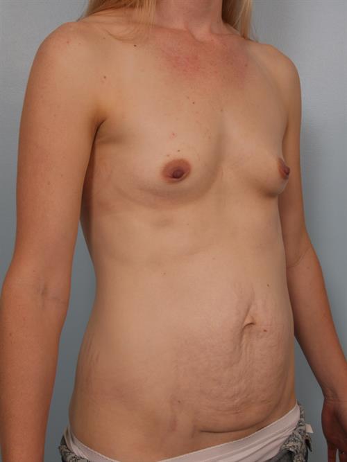 Breast Augmentation Before Photo | Phoenix and Scottsdale, AZ | Scottsdale Center for Plastic Surgery