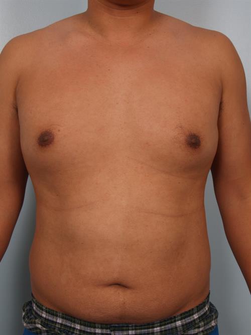 Male Liposuction Before Photo | Phoenix and Scottsdale, AZ | Scottsdale Center for Plastic Surgery