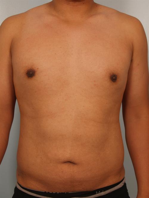 Male Liposuction After Photo | Phoenix and Scottsdale, AZ | Scottsdale Center for Plastic Surgery