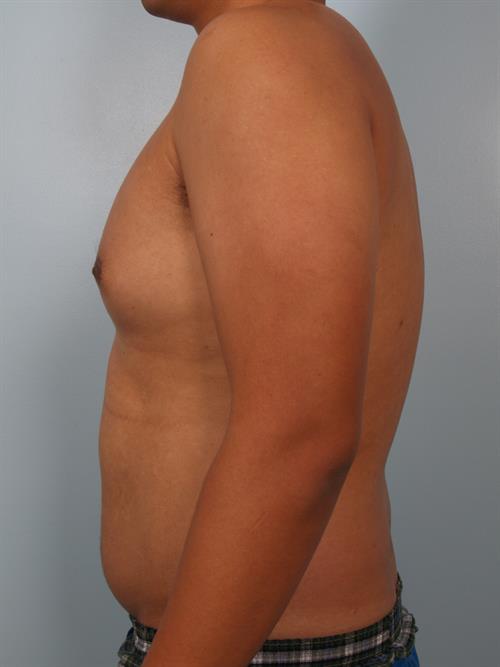 Male Breast/Areola Reduction Before Photo | Phoenix and Scottsdale, AZ | Scottsdale Center for Plastic Surgery