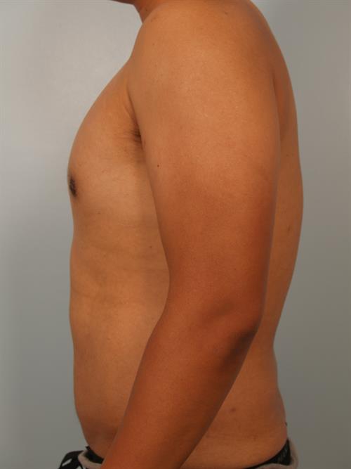 Male Breast/Areola Reduction After Photo | Phoenix and Scottsdale, AZ | Scottsdale Center for Plastic Surgery