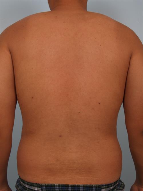 Male Breast/Areola Reduction Before Photo | Phoenix and Scottsdale, AZ | Scottsdale Center for Plastic Surgery