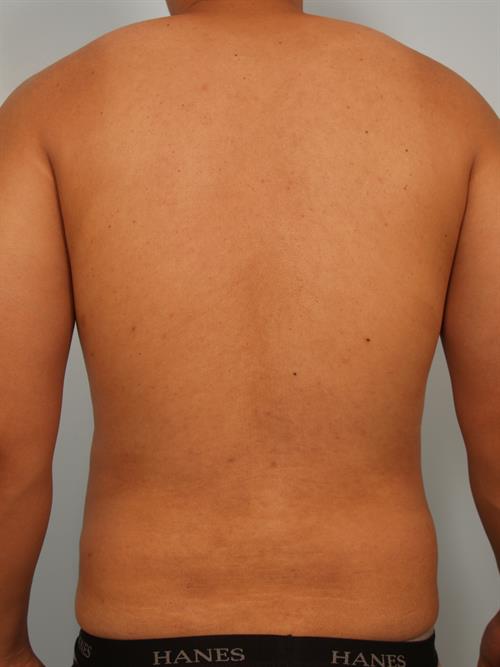 Male Breast/Areola Reduction After Photo | ,  | 