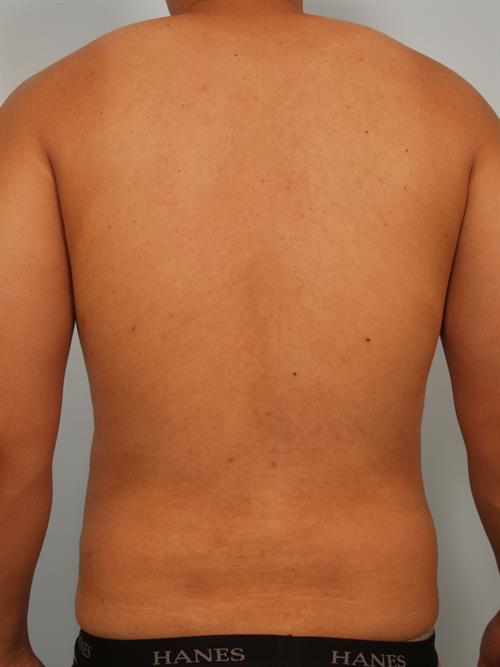 Male Breast/Areola Reduction After Photo | Phoenix and Scottsdale, AZ | Scottsdale Center for Plastic Surgery