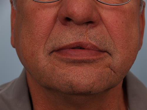 Restylane Before Photo | Phoenix and Scottsdale, AZ | Scottsdale Center for Plastic Surgery