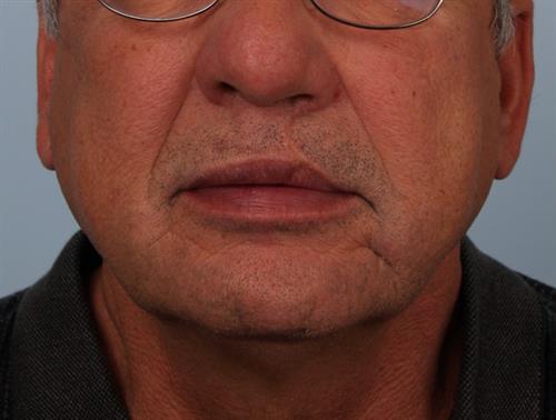 Restylane After Photo | Phoenix and Scottsdale, AZ | Scottsdale Center for Plastic Surgery