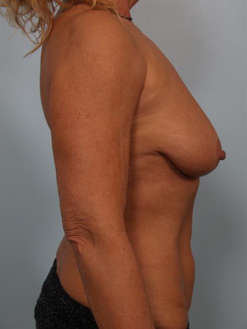 Breast Lift (Mastopexy) Before Photo | Phoenix and Scottsdale, AZ | Scottsdale Center for Plastic Surgery