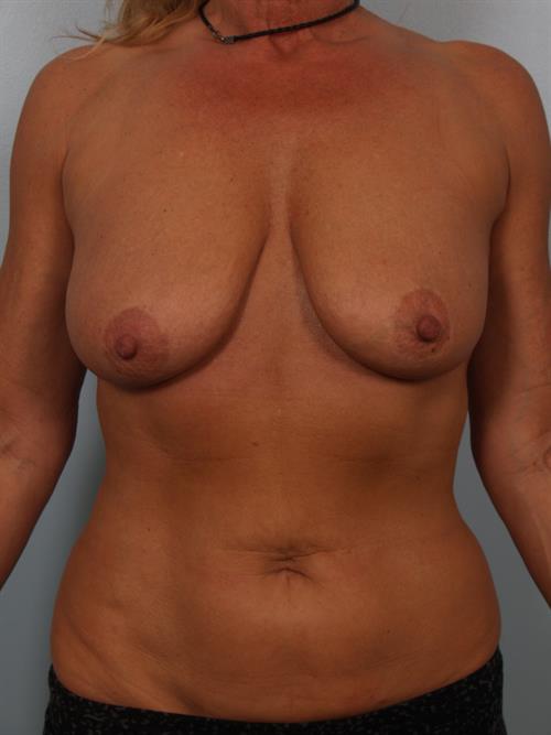Breast Lift (Mastopexy) Before Photo | Phoenix and Scottsdale, AZ | Scottsdale Center for Plastic Surgery
