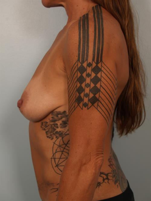 Breast Lift (Mastopexy) Before Photo | Phoenix and Scottsdale, AZ | Scottsdale Center for Plastic Surgery