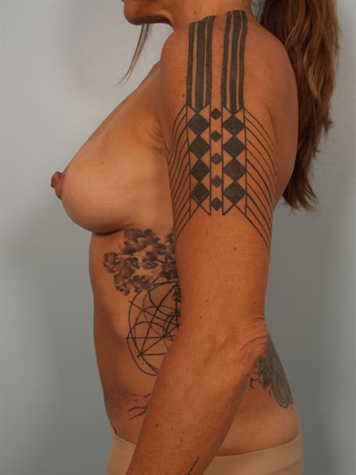Breast Lift (Mastopexy) After Photo | Phoenix and Scottsdale, AZ | Scottsdale Center for Plastic Surgery