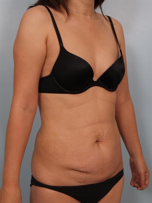 Tummy Tuck Before Photo | Phoenix and Scottsdale, AZ | Scottsdale Center for Plastic Surgery