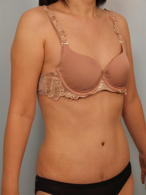 Tummy Tuck After Photo | Phoenix and Scottsdale, AZ | Scottsdale Center for Plastic Surgery