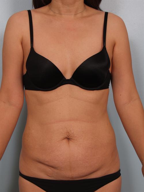 Tummy Tuck Before Photo | Phoenix and Scottsdale, AZ | Scottsdale Center for Plastic Surgery