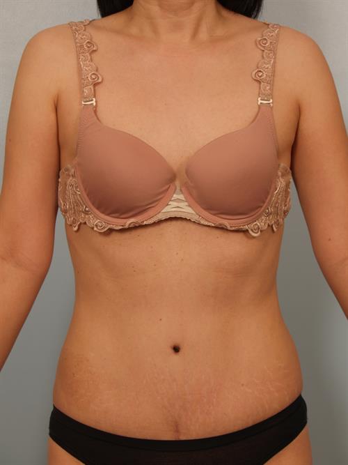 Tummy Tuck After Photo | Phoenix and Scottsdale, AZ | Scottsdale Center for Plastic Surgery