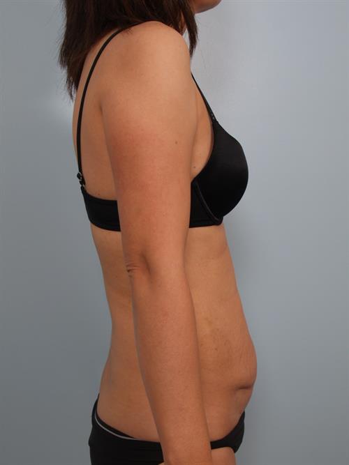 Tummy Tuck Before Photo | Phoenix and Scottsdale, AZ | Scottsdale Center for Plastic Surgery