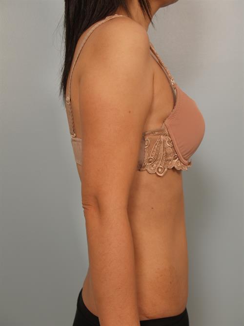 Tummy Tuck After Photo | Phoenix and Scottsdale, AZ | Scottsdale Center for Plastic Surgery