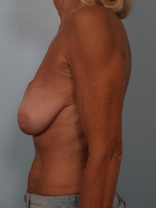 Revision Breast Surgery Before Photo | Phoenix and Scottsdale, AZ | Scottsdale Center for Plastic Surgery