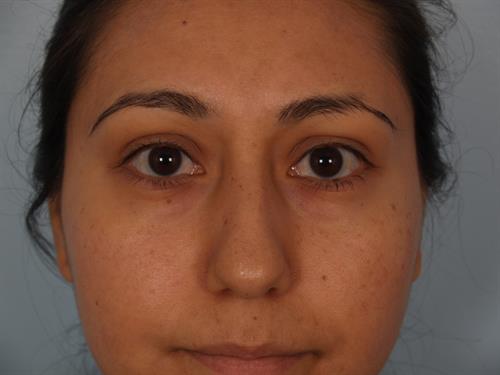 Facial Liposuction Before Photo | ,  | 