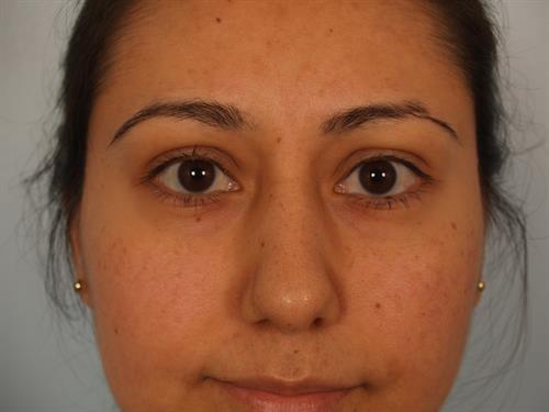 Facial Liposuction After Photo | Phoenix and Scottsdale, AZ | Scottsdale Center for Plastic Surgery