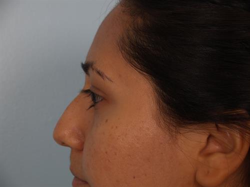 Facial Liposuction Before Photo | Phoenix and Scottsdale, AZ | Scottsdale Center for Plastic Surgery