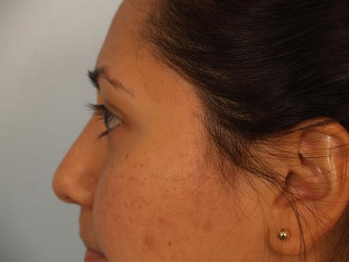 Facial Liposuction After Photo | Phoenix and Scottsdale, AZ | Scottsdale Center for Plastic Surgery