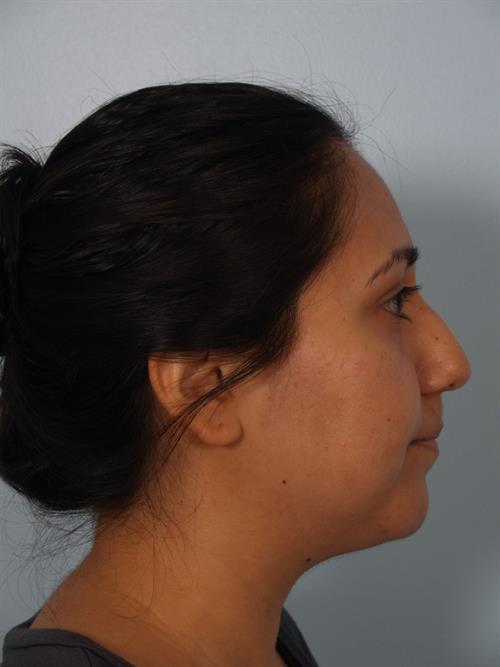 Facial Liposuction Before Photo | Phoenix and Scottsdale, AZ | Scottsdale Center for Plastic Surgery