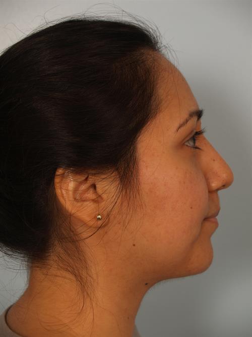 Facial Liposuction After Photo | Phoenix and Scottsdale, AZ | Scottsdale Center for Plastic Surgery