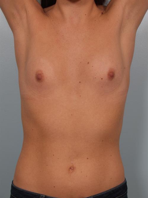 Breast Augmentation Before Photo | Phoenix and Scottsdale, AZ | Scottsdale Center for Plastic Surgery