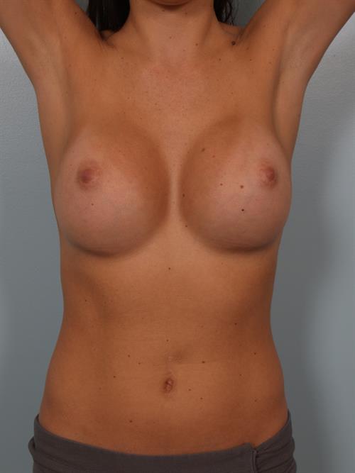 Breast Augmentation After Photo | Phoenix and Scottsdale, AZ | Scottsdale Center for Plastic Surgery