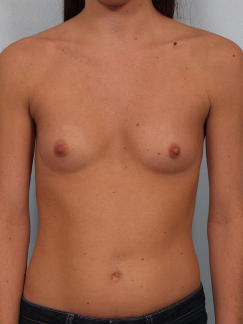 Breast Augmentation Before Photo | Phoenix and Scottsdale, AZ | Scottsdale Center for Plastic Surgery