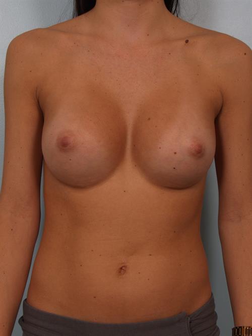 Breast Augmentation After Photo | Phoenix and Scottsdale, AZ | Scottsdale Center for Plastic Surgery