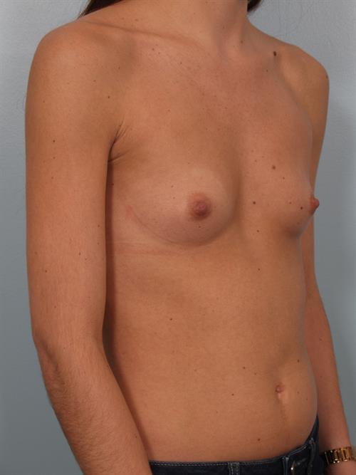 Breast Augmentation Before Photo | Phoenix and Scottsdale, AZ | Scottsdale Center for Plastic Surgery