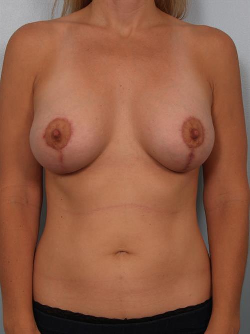 Breast Augmentation After Photo | Phoenix and Scottsdale, AZ | Scottsdale Center for Plastic Surgery