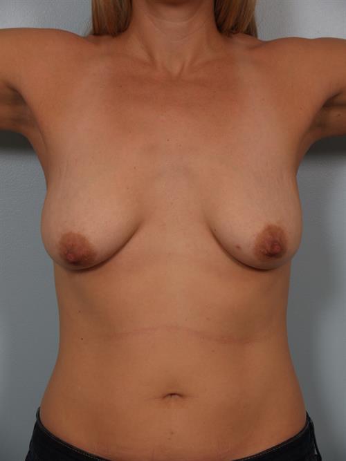 Breast Augmentation Before Photo | Phoenix and Scottsdale, AZ | Scottsdale Center for Plastic Surgery