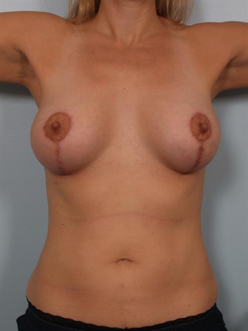 Breast Augmentation After Photo | Phoenix and Scottsdale, AZ | Scottsdale Center for Plastic Surgery