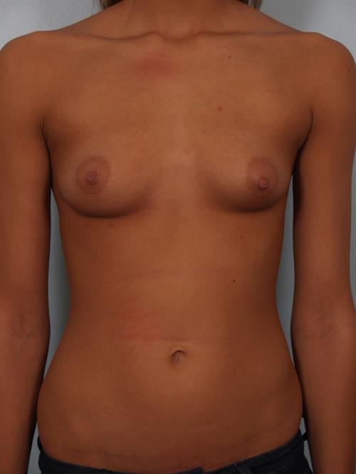 Breast Augmentation Before Photo | Phoenix and Scottsdale, AZ | Scottsdale Center for Plastic Surgery
