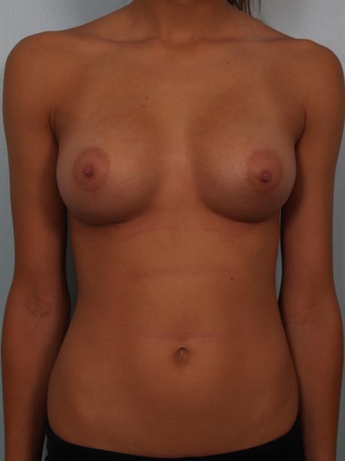 Breast Augmentation After Photo | Phoenix and Scottsdale, AZ | Scottsdale Center for Plastic Surgery